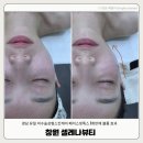 마산피부관리 창원 셀레나뷰티 페이스핏톡스 꺼진 볼륨 윤곽관리 1회만에 개선