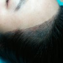 수정헤어라인 네이버블로그