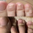 새천지약국 | 여자 발톱무좀 연고 스프레이 관리 경과