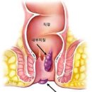 치질 증세 치핵 증상 내치핵 외치핵 자연 치료 (항문 통증 피 출혈 튀어나옴 탈항) 이미지