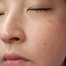 인천제일의원 | 한상희피부과 | 인천 점제거 잡티제거 잘하는 곳 레이저 시술 후기