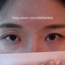 카성형외과 | 강남성형외과 겹주름 쌍꺼풀 / 함몰눈 발품 후기 2 그리고 수술후