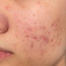 인진약국 | 여드름성 피부 N년차의 클렌징 스킨케어 관리법 총정리