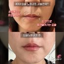 홍대아이디의원 | 얇은입술 필러, 왜 점점 말려 들어갈까요? (해결방법 공개)