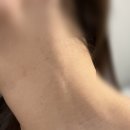 노벨약국 | [일상] 아가파의원 광명점 | 점 비립종 편평사마귀 쥐젖 제거 1,100원 솔직후기 노벨의원 영등포점