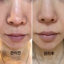 모공 줄이는법 진짜? 1회만에 모공이 바뀐 코 블랙헤드 제거 모공청소기 후기&amp;공구