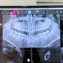 이레약국 | 구월동 서울이턱치과 신경에 닿은 매복 사랑니 당일 발치 후기 (주차, 실밥, 식사 등)