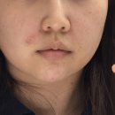 논현모두약국 | 신논현역피부과 스킨부스터 쥬베룩 볼륨 팔자주름 2cc 내돈내산 후기 통증 가격