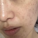 신&손비뇨기과의원 | 선릉 힐비뇨기과 잡티제거 예약 꿀팁 대방출 내돈내산 후기