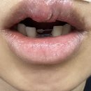와용 | 안면 바닥에 박아서 앞니8개 빠지고 코골절되어서 구급차 실려간 썰 푼다.