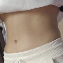 세이예스의원 - 복부지방흡입 아랫배, 윗배+옆구리+러브핸들 3달차 후기 전후사진 기록🧾