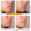 오렌지성형외과의원 | 인중축소,입술축소 은 돌출입에 비추!! 돌출입수술(ASO) 강추!!