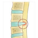 교통사고로 인한 추간판탈출증(DISK) 제대로 보상받자. 이미지