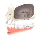 [방배서울하이안치과] 고난도 임플란트 – 상악동 거상술 (Lateral Approach)
