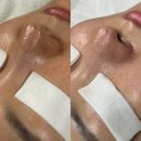낙동초교 | 하단 달리핀 에스테틱 나비존 모공 박살 내고 온 찐후기