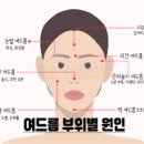 얼굴 부위별 여드름 나는 원인 코 볼 턱 인중 이마 여드름 여드름 없애는 법 뾰루지 이미지