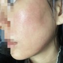PN리빌더 R 스킨부스터 포텐자 강남역 피부관리 한의원 비용 효과 후기