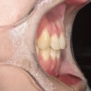두정서울비디치과 발치 교정의 정석