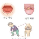 베체트병 증상 및 원인과 검사 치료 이미지