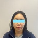 학동역피부과 얼굴 리부트 프로젝트울쎄라+온다+리쥬란찐후기