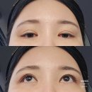 창원 제시뷰티 눈썹 아이라인 제거 2회차 후기