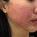 상주바른한의원 | 부산 피부관리추천 모공탄력 컨택터 효과 후기
