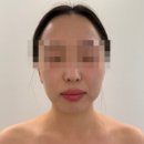 일성메디칼 | 부산 웨딩관리 연산동 피부관리 리하에스테틱 윤곽 리프팅