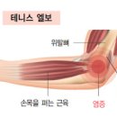 팔꿈치 통증 증상 테니스엘보 골프엘보 치료 이미지