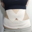 세이멍 | 세이예스의원 - 뱃살 복부지방흡입 1주차 후기 전후사진 기록🧾