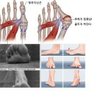 자가운동 표준 프로그램 | 무지외반증 수술 전, 꼭 해야할 자가진단과 7가지 운동법