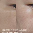 (주)두리번 | 서대신동피부관리 고민될 때 찾은 리에스테틱 플라즈마 잡티제거 솔직후기