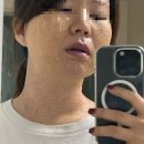 연세가정의원내 | <합정> 연세보드미의원 편평사마귀 얼굴&목 전체 제거 후기_2편