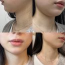 동생한의원 | 범계역한의원 이중턱살제거 지방분해 침 주사 솔직후기 (1차)
