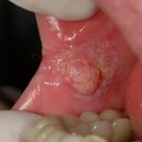 구강암[oral cavity cancer] 이미지