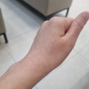 용인마디튼튼재활의학과의원 | 엄지손가락 마디 관절 손목 찌릿한 통증 건초염 증상