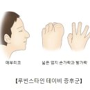 루빈스타인 테이비 증후군(Rubinstein-Taybi syndrome) 유전질환이란? 이미지