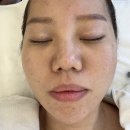 [울산여드름] 울산 “오늘도관리중”에서 여드름압출+물방울재생관리 솔직리뷰