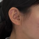 귀일지 | 청담동 피부과 귀필러 통증부터 효과까지 솔직후기