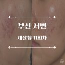 도O한의원 | 부산 새살침 11회차 후기 :: 부산 여드름 흉터 한의원