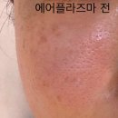 옥헤어모드 | 수원 여드름관리 압출 잘하는 레브메디스파 플라이저 에어플라즈마 만족 후기