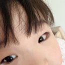 소아유치원 | 대구 누네안과 소아사시수술 후기 (당일~경과)｜이세엽 원장님