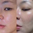 청담동 | 엘라비에리투오 스킨부스터 주사 청담동피부과 후기