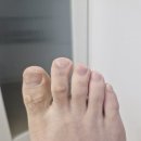 [큐라이드 토네일 솔루션] 문제성발톱앰플 리얼 후기! 두꺼워진 발톱 고민 이제 안녕~
