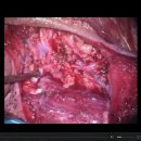How To Save The Facial Nerve During Parotid Gland Surgery 이미지