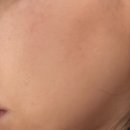 어썸메디칼(awesome medical) | I 인천 송도에스테틱 I 어썸마인 I 모공 고민, 프렉셀서마지 후기