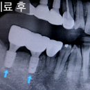 뿌리튼튼수치과의원 | 잇몸뼈 녹음? 잇몸뼈 녹음 심했지만 뼈이식 후 튼튼하게 임플란트 치료해 드린 후기 [공덕동임플란트]