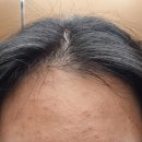 가은병원 | 망포 가은에스테틱 피부구원 SOS압출케어 전/후비교 내돈내산 솔직후기
