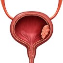 방광암 환자 10년새 45%↑…&#34;5대 예방수칙 알아둬야&#34; 이미지