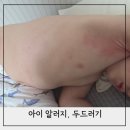 챔프이야기 | 아기 두드러기 알러지 실제 후기 응급실 가기 전 상비약 챔프 알러논 추천