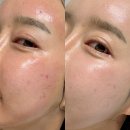 재생크림 파이토신 MTS홈케어 부작용 진정관리